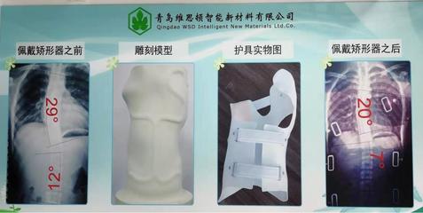 拯救&ldquo;維納斯&rdquo; 「維思頓」開(kāi)創(chuàng)數(shù)字化仿真智能矯形